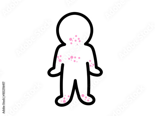 発疹がでる　ストレス