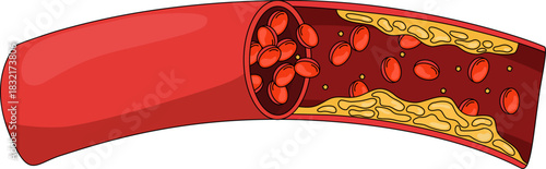 Detailed cross-sectional diagram of an artery with atherosclerosis, concept of cholesterol plaque buildup, severe cardiovascular disease, and blocked blood flow