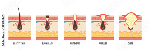 Human skin structure. Acne types. Vector flat illustration isolated on white background.
