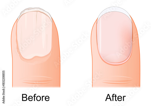 Nail care. Manicure before and after. Nail hygiene