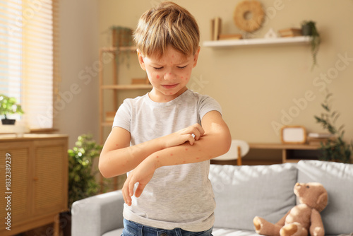 Fotografie Little boy ill with chickenpox scratching his arm at home