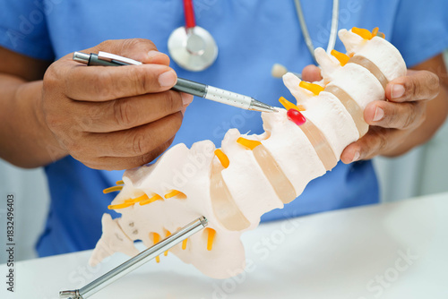 Asian doctor holding spinal nerve and bone model, Lumbar spine displaced herniated disc fragment for treatment medical in the orthopedic department.