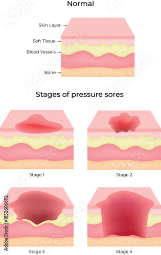 Stages of Pressure Sores Vector Illustration
