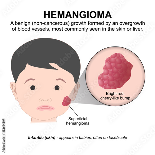 Hemangioma benign vascular tumor, haemangioma flashcard illustration