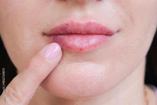 Bild auf Leinwand Women's lips on the second day after the introduction of hyaluronic acid, lip he