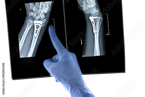 Hand finger in glove points X-ray of hand surgical options for treating a distal radius fracture Inserting a purpose-built orthopaedic plate with open reduction internal fixation frontal lateral view