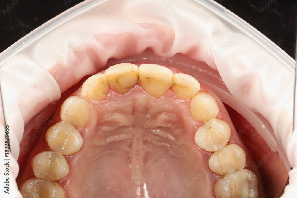 Obraz premium Upper oral cavity with teeth, gums, and palate clearly visible, using a cheek retractor during a dental procedure for hygiene or restorative dentistry