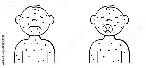 Skin rash, measles on young child and baby face. Rash on the body. A sign of measles, lupus, herpes, or rubela, and other autoimmune diseases. Rubeola or morbilli symptom. food allergy. Itchy skin.