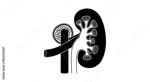 Kidney Stone Illustration Medical Diagram of Urinary System.