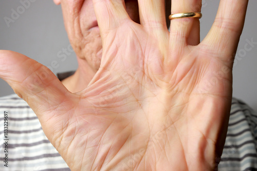 Senior Man Demonstrating his Dupuytren Contracture on the palm of his hand