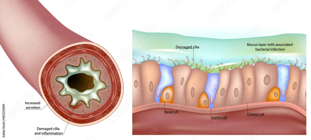 Φωτογραφία Medical illustration showing damage to the respiratory epithelium, impaired cilia, increased mucus production, airway inflammation, and bacterial infection
