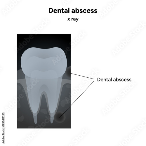 X-ray view of tooth with dental abscess. Illustration highlights the infected root area, bone loss, inflammation, and periapical infection visible on the radiograph