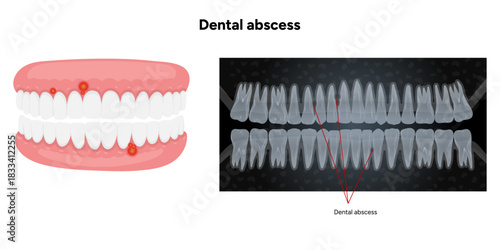 Hand-drawn dental infographic showing upper and lower teeth with dental abscess, including detailed jaw illustration