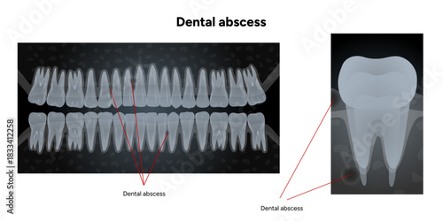Hand-drawn dental infographic upper and lower teeth with dental abscess, shown in X-ray style, including detailed X-ray illustration of single affected tooth