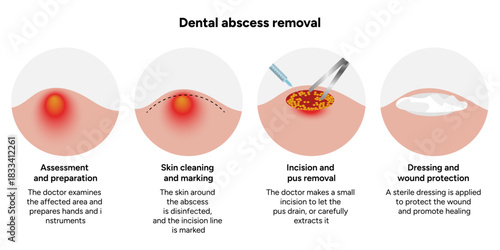Hand-drawn dental illustration showing process of dental abscess removal, including infected tooth, drainage, and cleaning stages