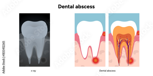Clear, minimal medical diagram showing the basic anatomy of tooth affected by dental abscess and x ray