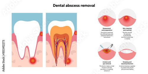 Hand-drawn dental illustration showing the process of dental abscess removal, including the infected tooth, drainage, and cleaning stages. With health and problem tooth