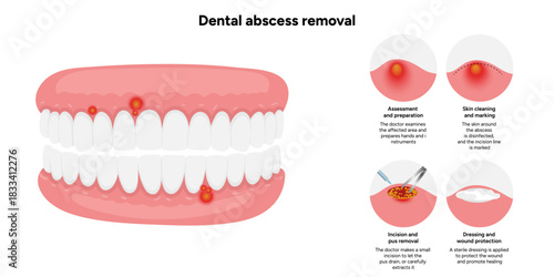 Hand-drawn dental illustration showing the process of dental abscess removal, including the infected tooth, drainage, and cleaning stages. With illustration of problem jaw