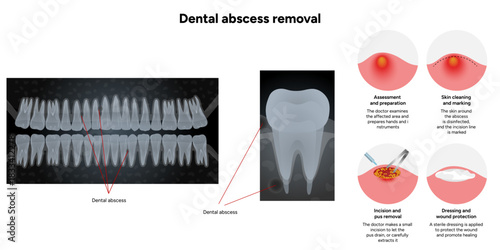 Hand-drawn dental illustration showing the process of dental abscess removal, including the infected tooth, drainage, and cleaning stages. With x ray illustration 