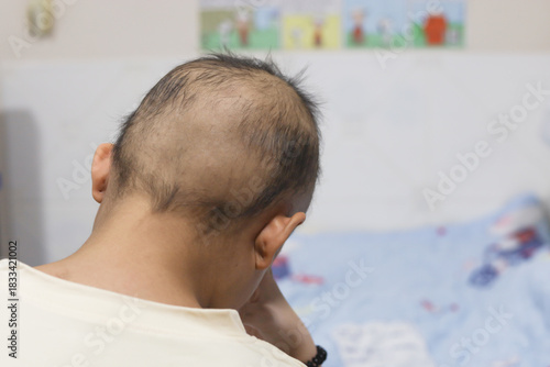 A young woman with cancer sits stressed in her room. Chemotherapy causes her hair to fall out.