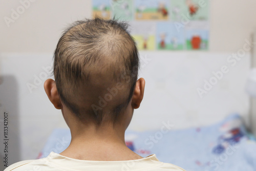 A young girl with cancer sits stressed in her room. Chemotherapy causes her hair to fall out.