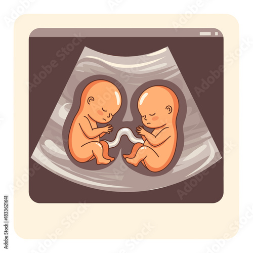 Ultrasound image showing two sleeping fetuses connected by an umbilical cord, illustration of twin pregnancy