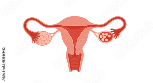Anatomical illustration of the female reproductive system showing polycystic ovary syndrome with multiple cysts on the ovaries.