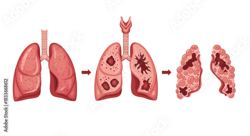Illustration showing the progression of lung cancer or disease, from healthy lungs to lungs with developing and advanced tumors.