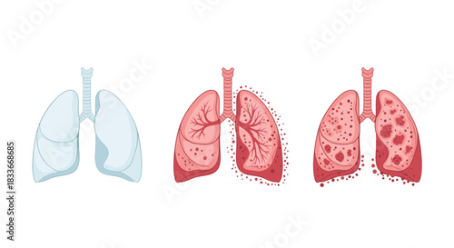Medical illustration showing the progression of a lung disease like tuberculosis, from healthy lungs to infected and damaged lungs.