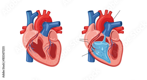 Comparison illustration of a normal heart cross-section versus a heart with pericardial effusion, showing fluid buildup around it.