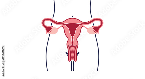 Anatomical illustration of the female reproductive system, including the uterus, ovaries, and fallopian tubes, shown within a body outline.