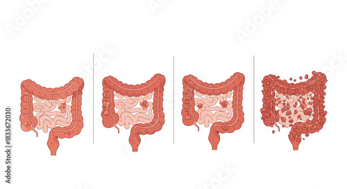 Medical infographic illustrating the four stages of colon cancer progression, from a small polyp to widespread metastatic disease.
