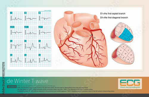 De Winter T wave is an electrocardiographic manifestation of acute coronary syndrome, where the culprit vessel is severe stenosis of the proximal left anterior descending artery.
