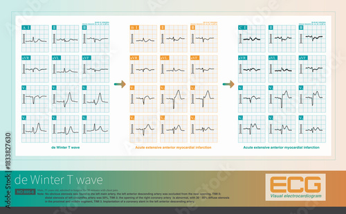 Obraz na plátne When the ST segment of the de Winter T wave changes from depressed to elevated, it indicates progression to acute AMI, with myocardial ischemia spreading from subendocardial to epicardial