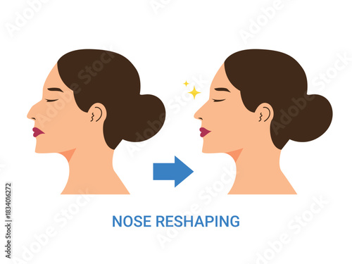 Plastic surgery, nose reshaping, facial reduction, before after rhinoplasty
