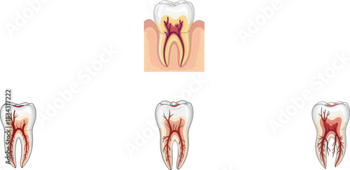 Medical dental anatomy diagram of healthy and infected tooth with root canal treatment showing inflamed red pulp and nerve for dentistry healthcare education concept.