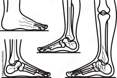 Fractures of human foot bones. Fractures in different places of the leg due to injury. Vector illustration. one line Icon drawing