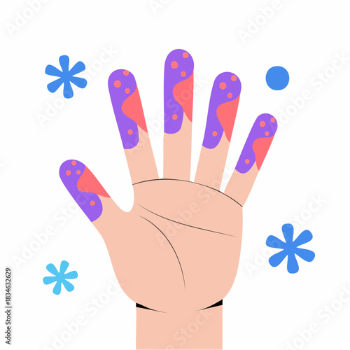 Illustration of a hand with symptoms of frostbite or Raynauds disease.