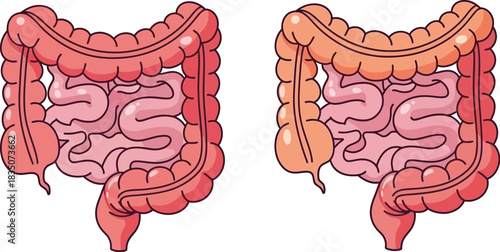 Healthy and unhealthy colon comparison digestive system anatomy illustration