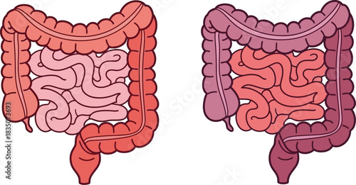 Healthy and unhealthy colon illustration showing digestive health comparison
