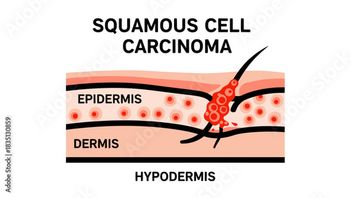 Squamous Cell Carcinoma (SCC): Skin Anatomy Diagram