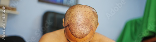 Wide frontal photograph of a freshly transplanted scalp showing newly implanted grafts extending across the hairline.