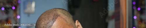 Close-up side view of the scalp after a hair transplant procedure, showing implanted grafts and early healing along the side hairline.
