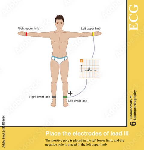 Lead Ⅲ is a standard limb lead, with the positive pole placed in the left lower limb and the negative pole placed in the left upper limb.
