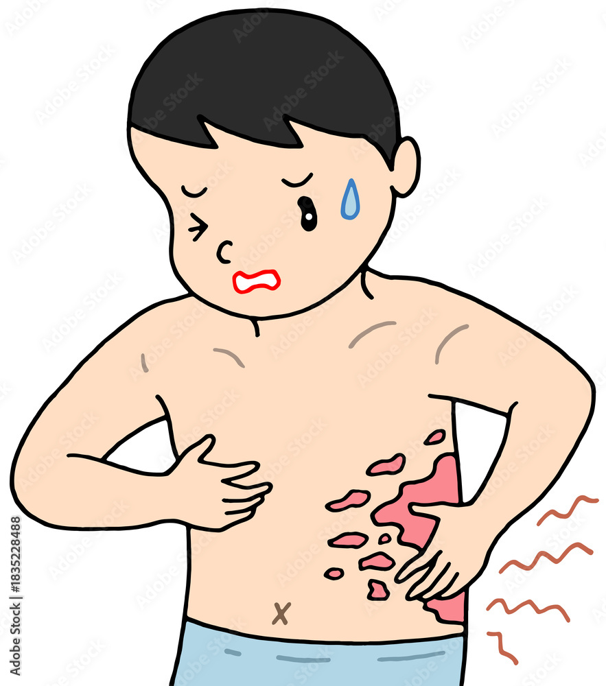 Fototapeta premium 病気・疾患のイラスト - 帯状疱疹・皮膚疾患・皮膚炎