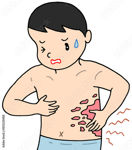 病気・疾患のイラスト - 帯状疱疹・皮膚疾患・皮膚炎