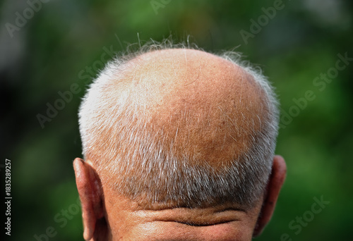 View of bald man's head 