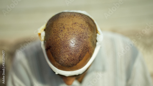 Close shot of the front scalp region showing freshly implanted grafts after a hair transplant. The image highlights early healing, uniform graft placement, and the post-surgery