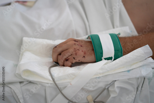 Patient hand with restraint strap and injury in hospital bed