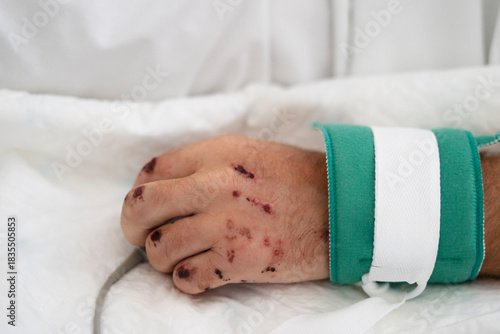 Patient hand with wounds in restraint at hospital